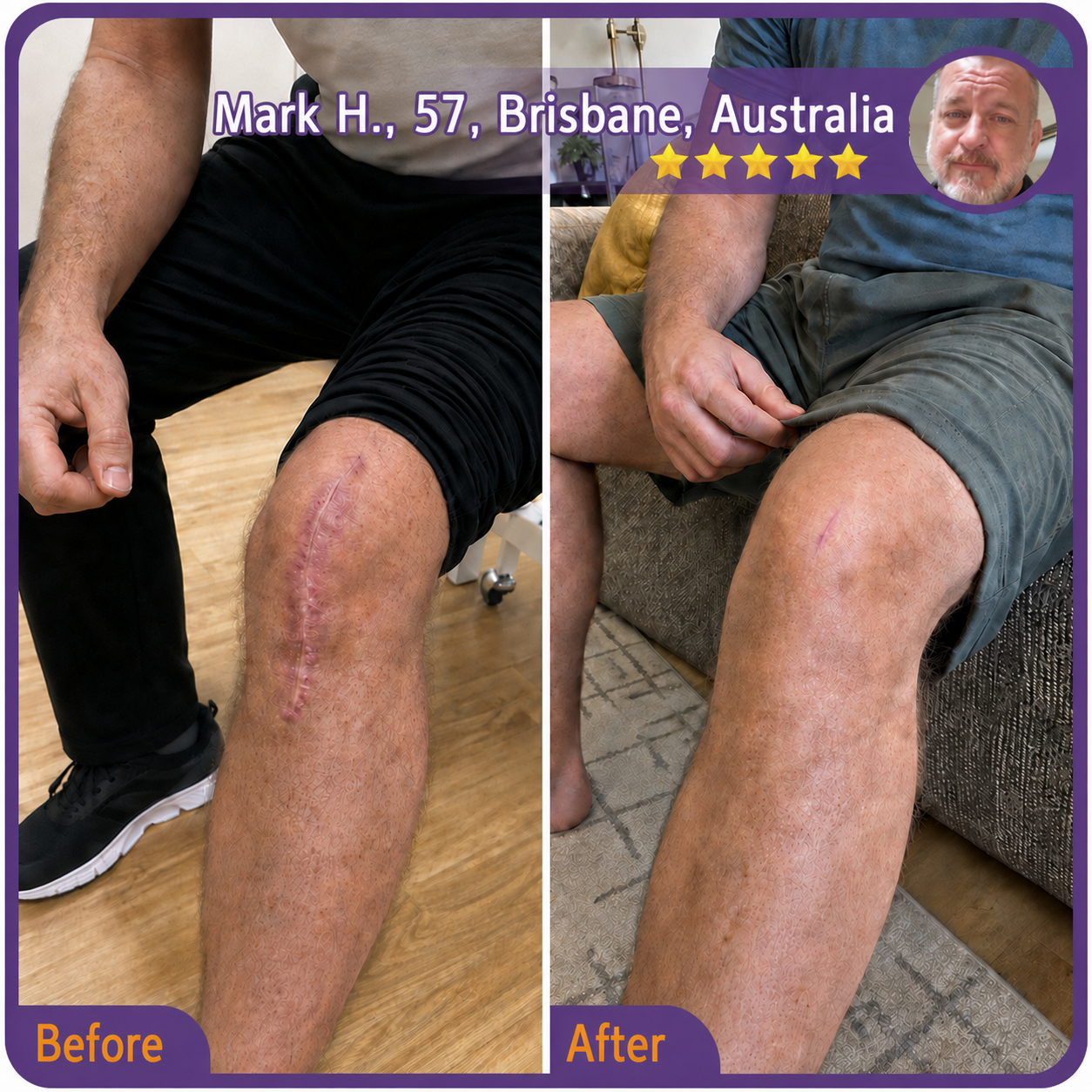 🇦🇺👨⚕️Trilumia® Medical-Grade Silicone Scar Repair Roller (For Raised, Red, Firm, Tight & Discoloured Surgical Scars)