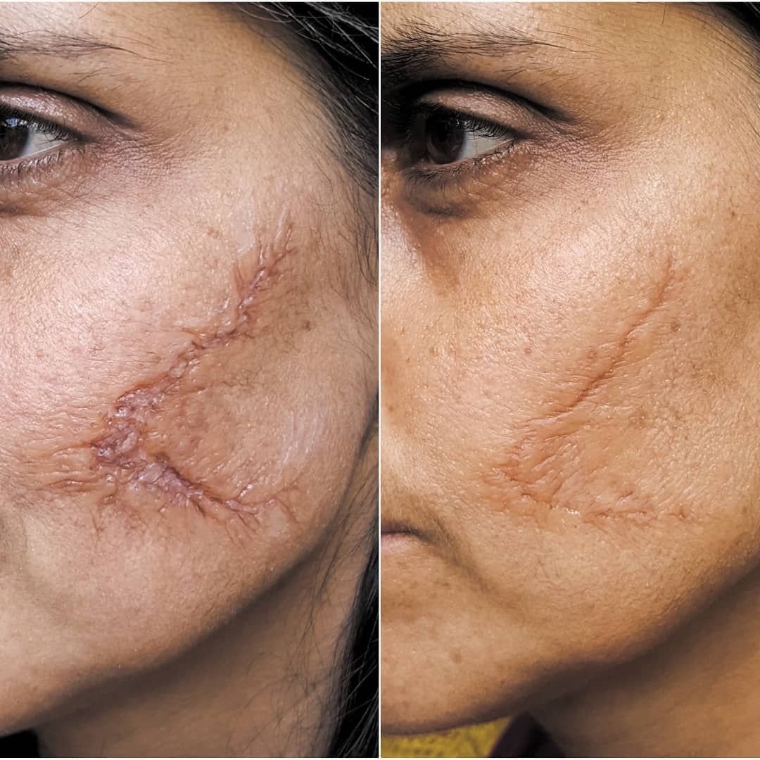 Scar comparison example 1