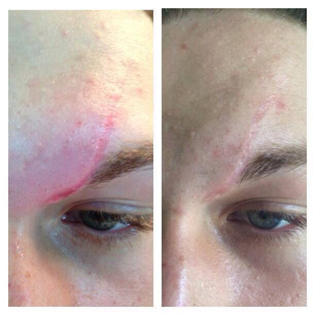 Scar comparison example 7