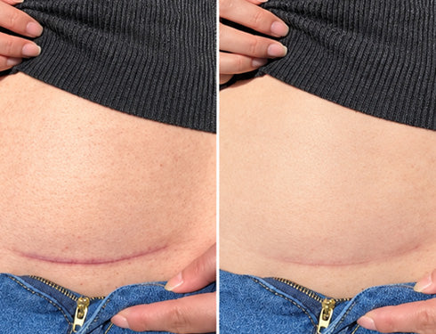 Scar comparison example 11