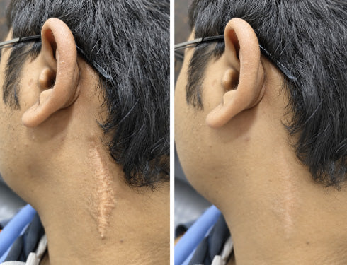 Scar comparison example 13
