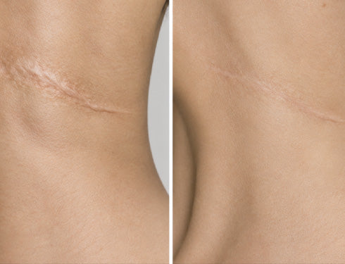 Scar comparison example 16