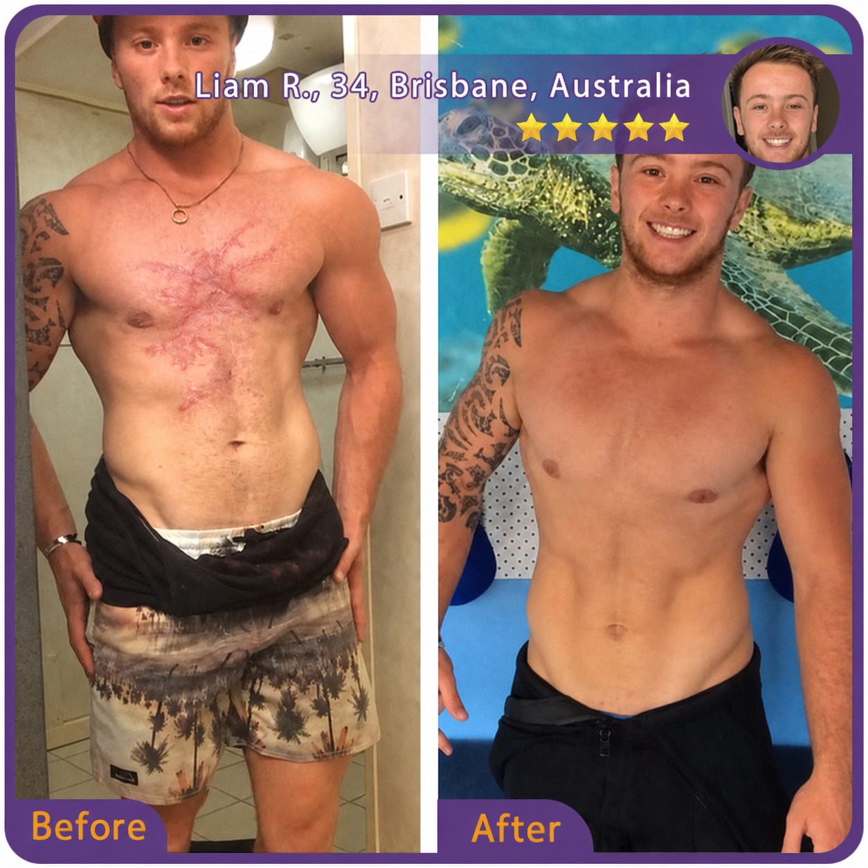 🇦🇺👨‍⚕️Trilumia® Medical-Grade Silicone Scar Repair Roller (For Raised, Red, Firm, Tight & Discoloured Surgical Scars)