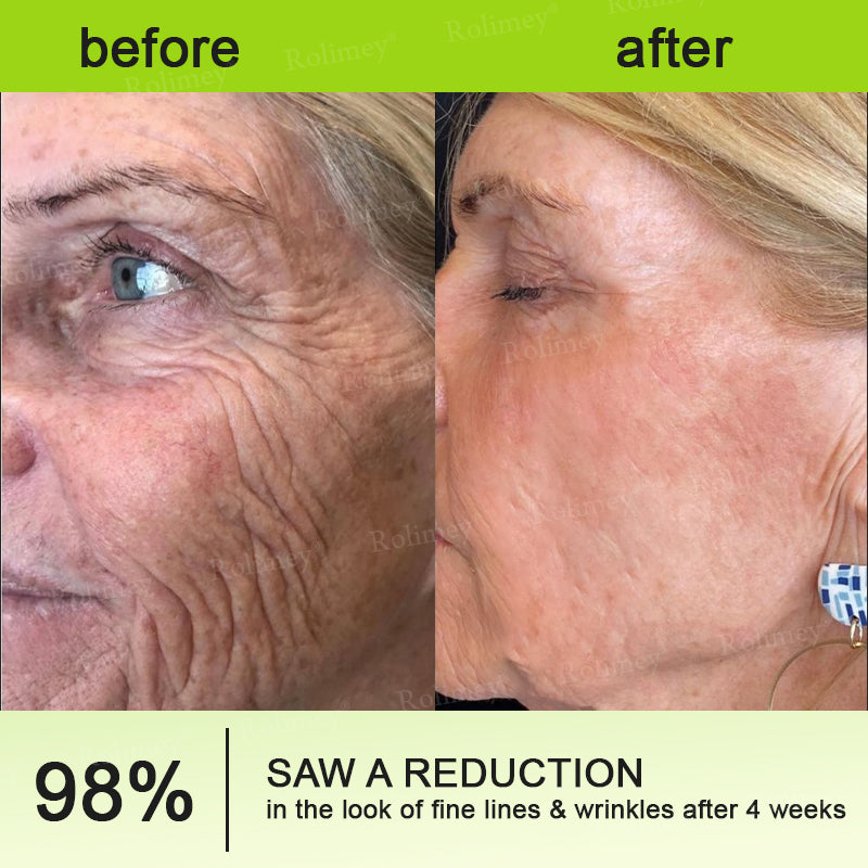 ❤️ ✨Made and shipped from Australia 💫Rolimey® Botox & Vita-A Retinol Shot Wrinkle-Lift Tightening cream - Last Day Promotion 50% OFF