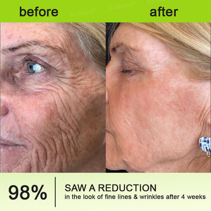 ❤️ ✨Made and shipped from Australia 💫Rolimey® Botox & Vita-A Retinol Shot Wrinkle-Lift Tightening cream - Last Day Promotion 50% OFF