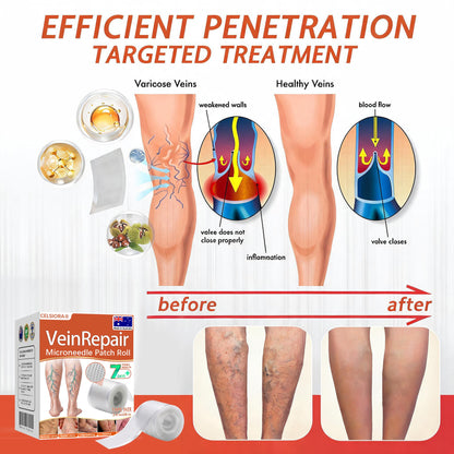 🌟🌿Official AU Store 🇦🇺 | Celsiora® Vein Ease Microneedle Care Patch(For Spider Veins, Varicose Veins, Swelling & Leg Fatigue) - Last Day Promotion 50% OFF