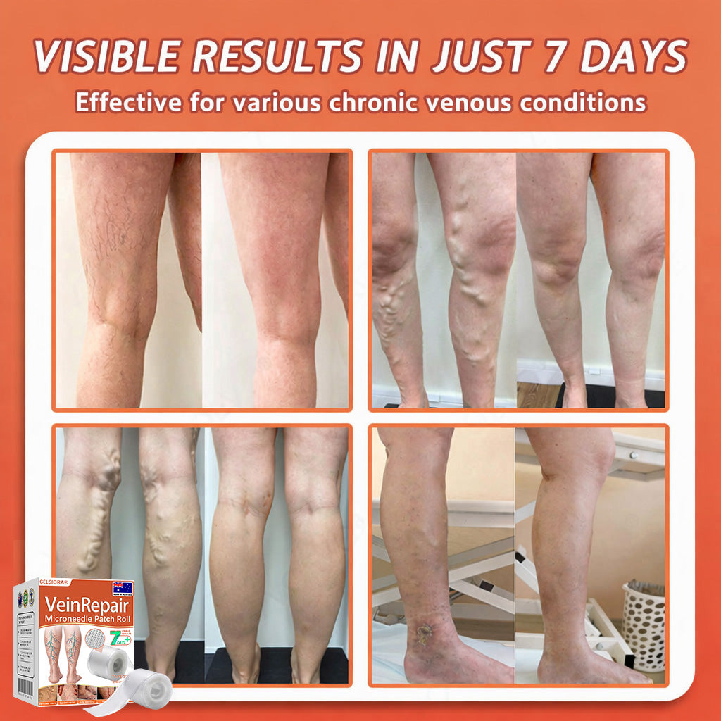 🌟🌿Official AU Store 🇦🇺 | Celsiora® Vein Ease Microneedle Care Patch(For Spider Veins, Varicose Veins, Swelling & Leg Fatigue) - Last Day Promotion 50% OFF