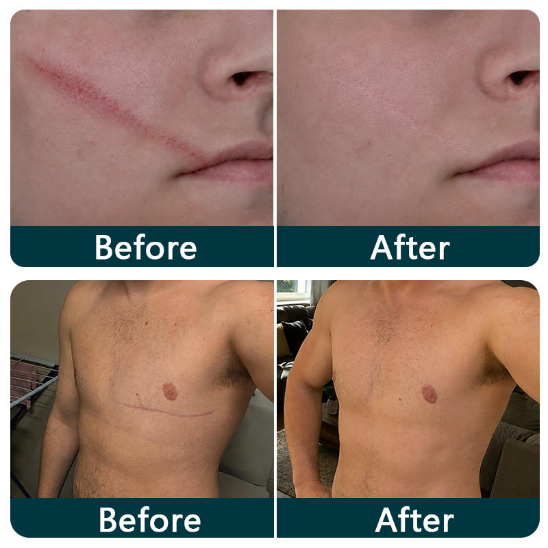 🇦🇺🎁🧚TRILUMIA® SILICONE SCAR THERAPY ROLL Help Soften, Flatten & Improve the Appearance of Raised Scars