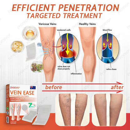 👨‍⚕️🌿Zvoevo® Vein Ease Microneedle Care Patch(For Spider Veins, Varicose Veins, Swelling & Leg Fatigue) - Last Day Promotion 50% OFF
