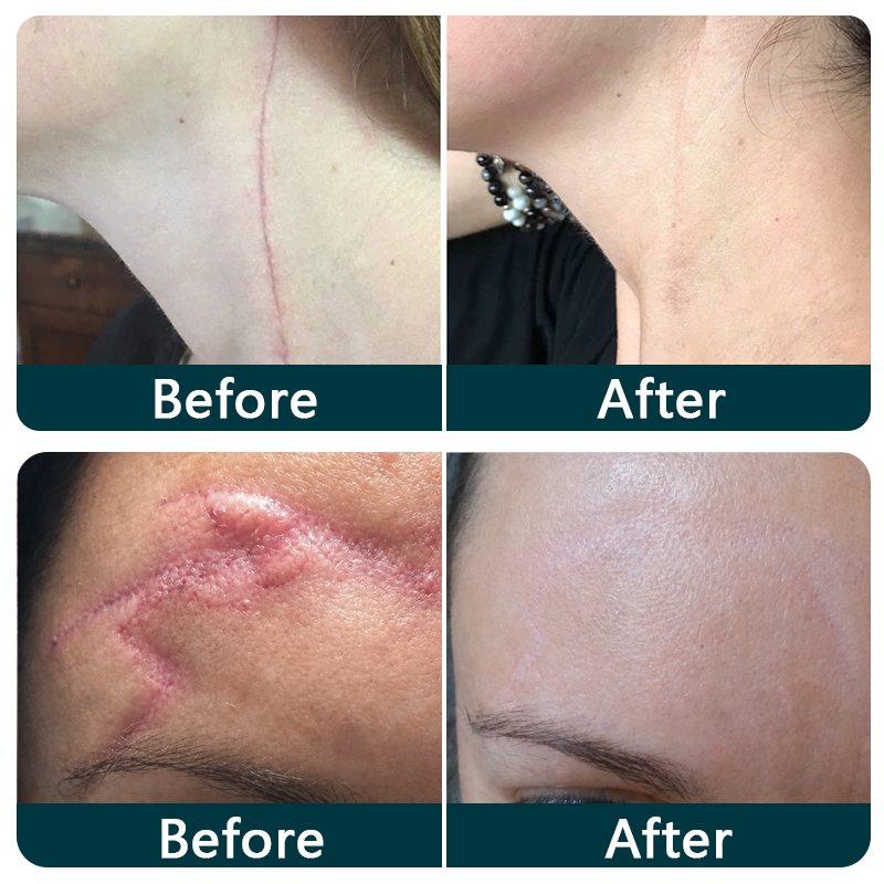 🇦🇺🎁🧚TRILUMIA® SILICONE SCAR THERAPY ROLL Help Soften, Flatten & Improve the Appearance of Raised Scars