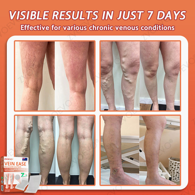 👨‍⚕️🌿Zvoevo® Vein Ease Microneedle Care Patch(For Spider Veins, Varicose Veins, Swelling & Leg Fatigue) - Last Day Promotion 50% OFF