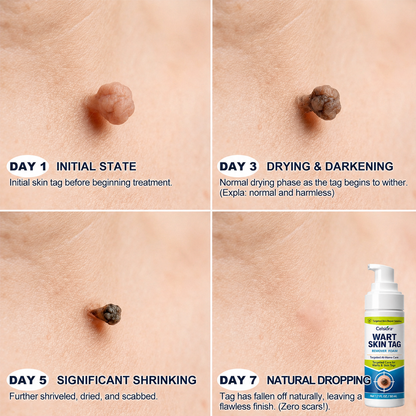 🇦🇺🌿🌿Celsiora® 7 Day Wart & Skin Tag Remover Foam (Targeted Solution for Warts, Skin Tags & Uneven Skin Texture)