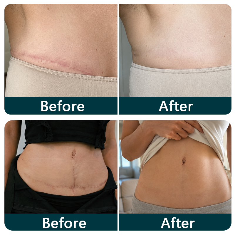 🇦🇺🎁🧚TRILUMIA® SILICONE SCAR THERAPY ROLL Help Soften, Flatten & Improve the Appearance of Raised Scars