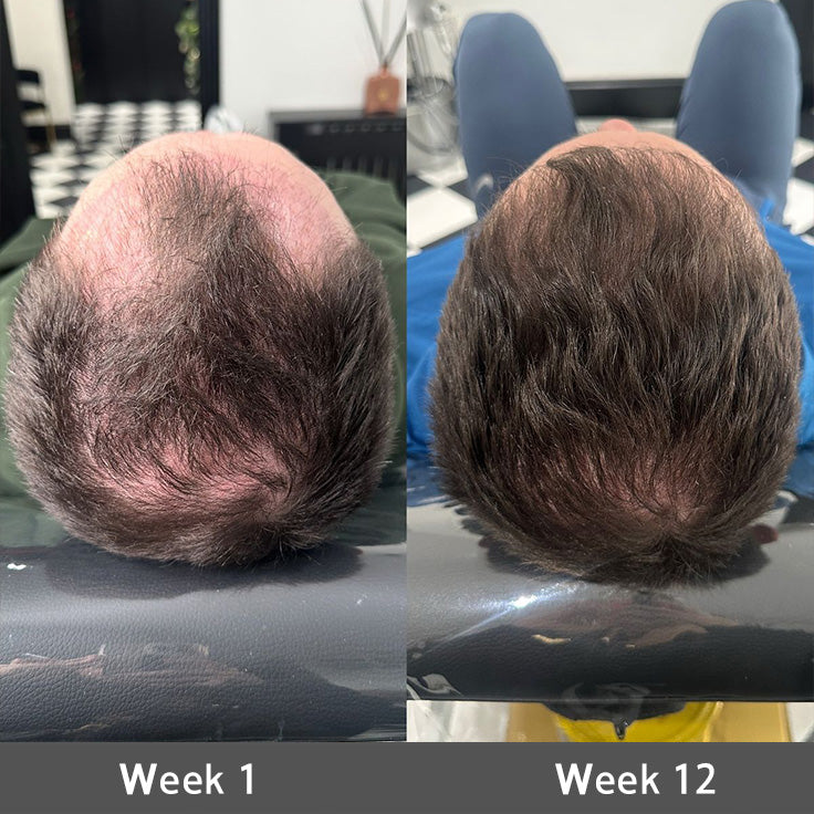 ☘️⏳Official AU Store 🇦🇺 | 🔥Rolimey® Highly Effective Biotin & Rosemary Hair Growth Serum — Visibly fills thinning areas & receding hairlines (🔥 Limited-Time Offer, ⏳ Last 30 Minutes)