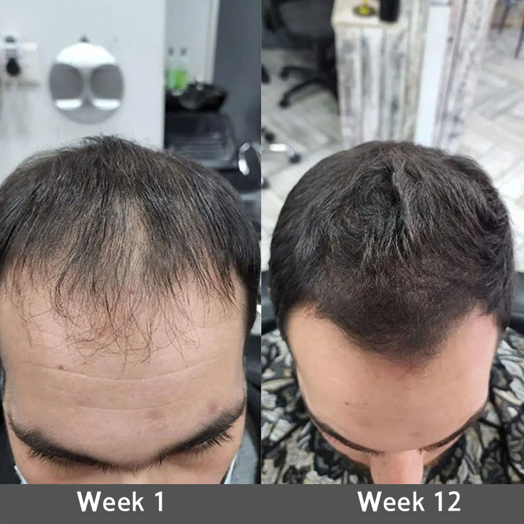 ☘️⏳Official AU Store 🇦🇺 | 🔥Rolimey® Highly Effective Biotin & Rosemary Hair Growth Serum — Visibly fills thinning areas & receding hairlines (🔥 Limited-Time Offer, ⏳ Last 30 Minutes)