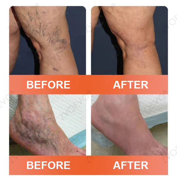 🌟🌿Official AU Store 🇦🇺 | Celsiora® Vein Ease Microneedle Care Patch(For Spider Veins, Varicose Veins, Swelling & Leg Fatigue) - Last Day Promotion 50% OFF