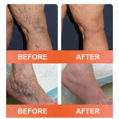 🌟🌿Official AU Store 🇦🇺 | Celsiora® Vein Ease Microneedle Care Patch(For Spider Veins, Varicose Veins, Swelling & Leg Fatigue) - Last Day Promotion 50% OFF