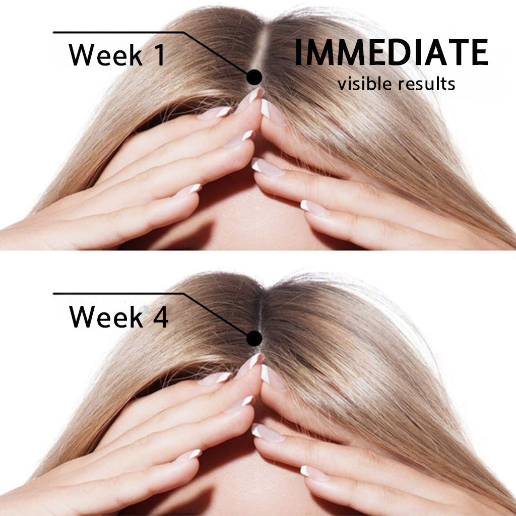 ☘️⏳Official AU Store 🇦🇺 | 🔥Rolimey® Highly Effective Biotin & Rosemary Hair Growth Serum — Visibly fills thinning areas & receding hairlines (🔥 Limited-Time Offer, ⏳ Last 30 Minutes)