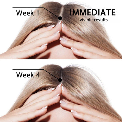 ☘️⏳Official AU Store 🇦🇺 | 🔥Rolimey® Highly Effective Biotin & Rosemary Hair Growth Serum — Visibly fills thinning areas & receding hairlines (🔥 Limited-Time Offer, ⏳ Last 30 Minutes)