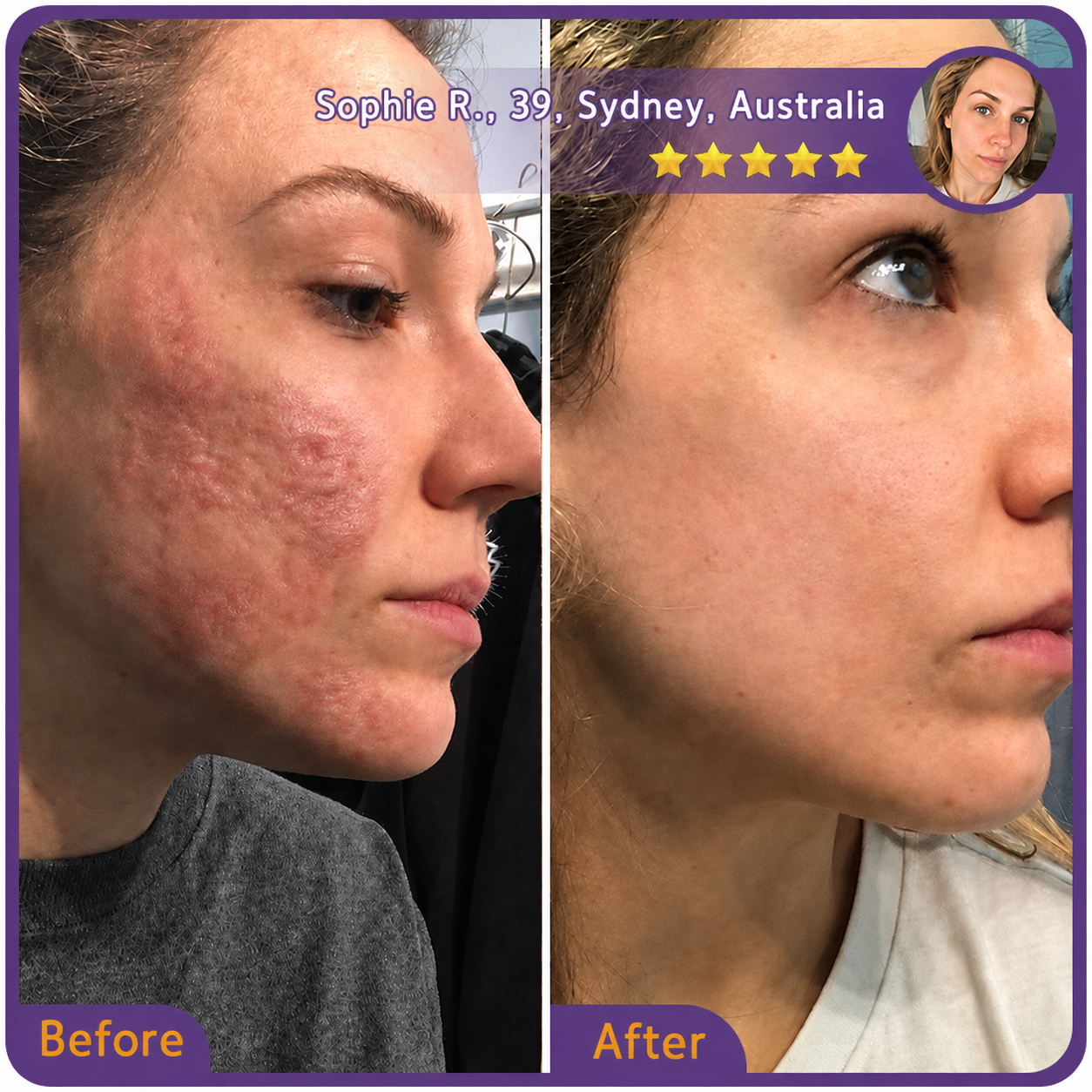 🇦🇺👨‍⚕️Trilumia® Medical-Grade Silicone Scar Repair Roller (For Raised, Red, Firm, Tight & Discoloured Surgical Scars)