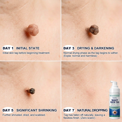 🇦🇺✨🌿Celsiora® 7 Day Wart & Skin Tag Remover Foam (Targeted Solution for Warts, Skin Tags & Uneven Skin Texture)