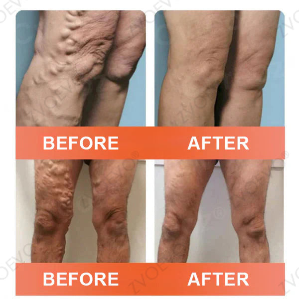 🌟🌿Official AU Store 🇦🇺 | Celsiora® Vein Ease Microneedle Care Patch(For Spider Veins, Varicose Veins, Swelling & Leg Fatigue) - Last Day Promotion 50% OFF