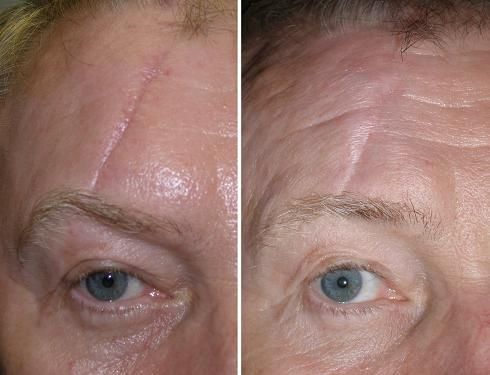 Scar comparison example 3