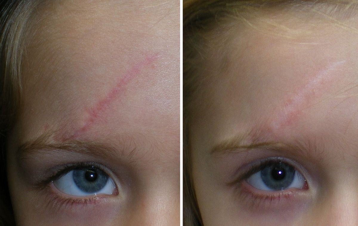 Scar comparison example 6