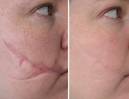 Scar comparison example 12