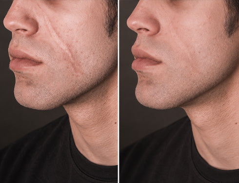 Scar comparison example 14